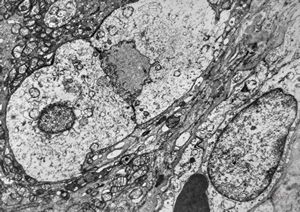 F,44y. | ependymoma F,44y. | ependymoma